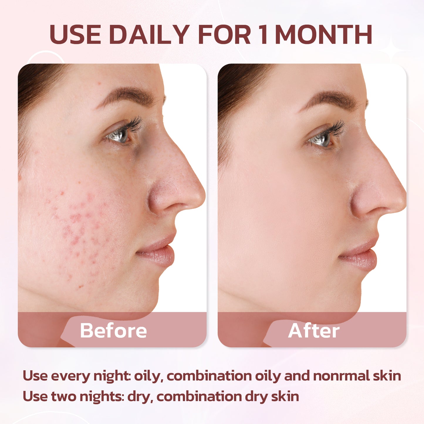 Acne Drying Lotion, 29ml / 0.98 fl.oz.