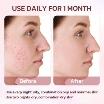 Acne Drying Lotion, 29ml / 0.98 fl.oz.