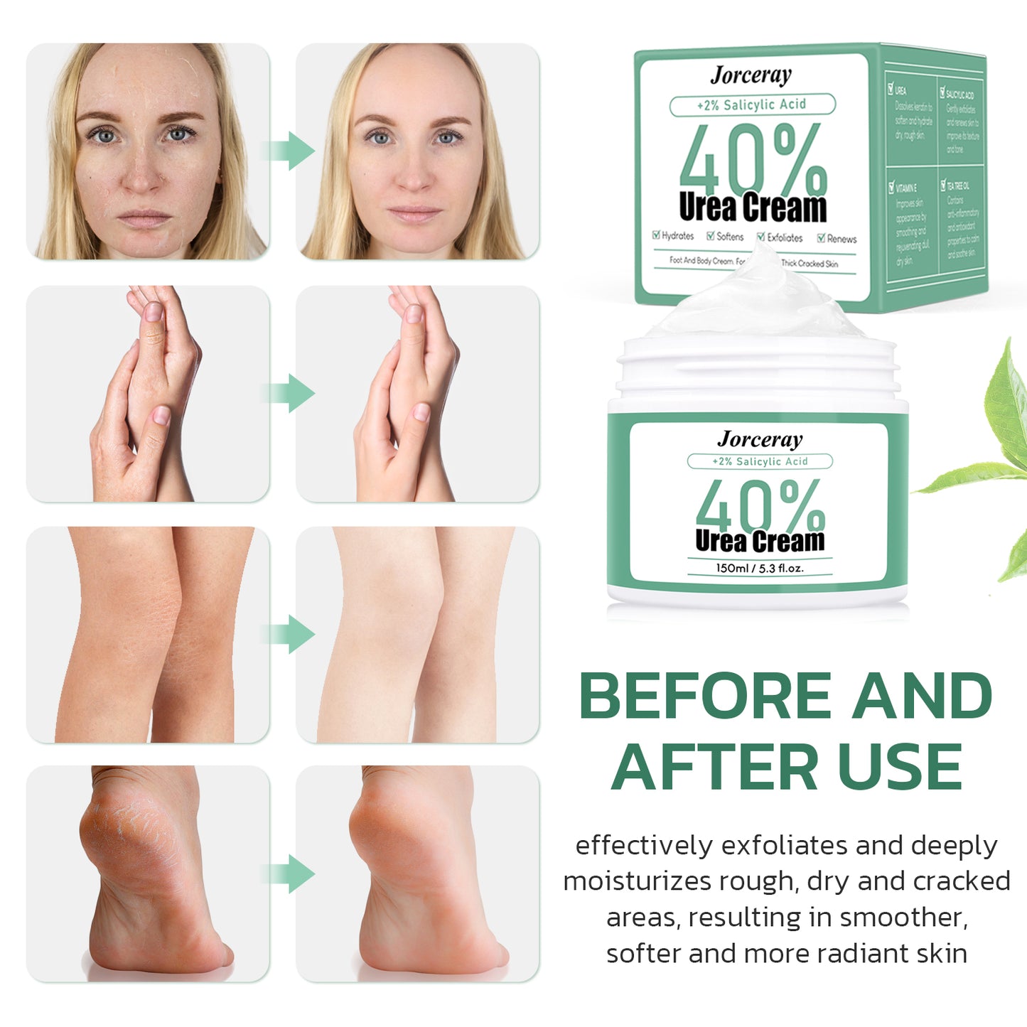 40% Urea Foot Cream, 150ml / 5.3 fl.oz.